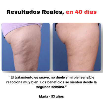 Reduce celulitis y moldea tu cuerpo desde casa.